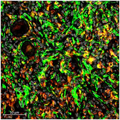 Editorial: Immune Landscape of Kidney Pathology